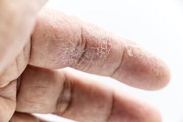 index finger skin disease on white background