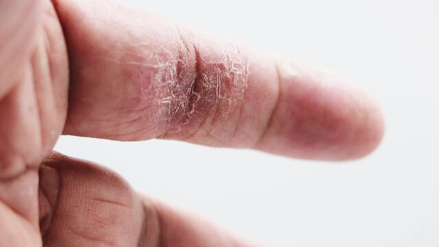 index finger skin disease on white background
