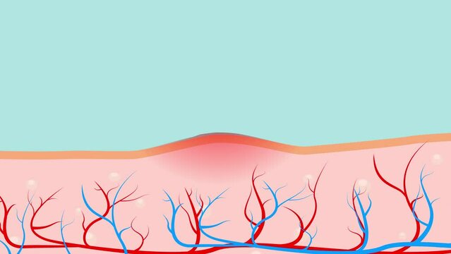 Human skin. Glands. Inflamed pimple on human skin