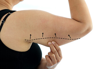 Plastic surgery doctor draw line on patient arm. Woman with excess fat on her upper arm with marks...
