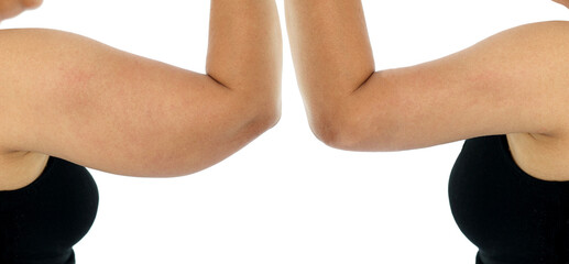 Comparison before and after Obesity Cellulite And Fat Removal liposuction Surgery on upper arm to...