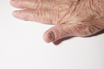 Fingernail of an elderly woman infected with fungal infection.