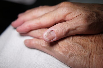 Fingernail of an elderly woman infected with fungal infection.