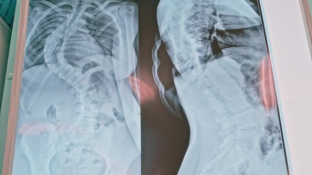 Lumbar spine x-ray