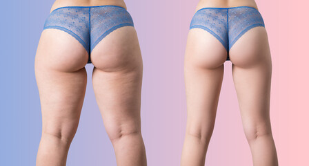 Overweight woman with fat cellulite legs and buttocks, before after weight loss concept on purple...