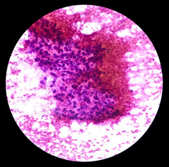 Elbow joint lesion(CT guided FNA): Tubercular arthritis, microscopic show epithelioid cells, lymphocytes, histiocytes, background of blood.
