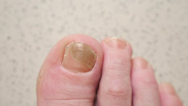 Toenails of woman with fungal infection. Brown bruise under nail of big toe. Senior woman touches injured toenail by index finge, top view
