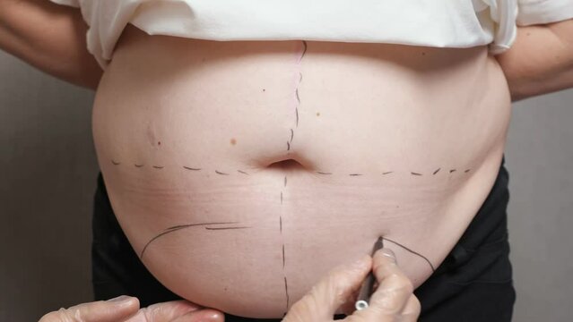 Surgeon draws correction marks on female sagging belly for plastic surgery. Black surgery lines for liposuction procedure on patient fat belly, close up