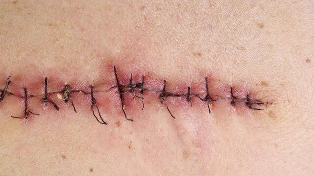 Medical sutures, stitch after surgery, stitched surgical sutures on human body.
