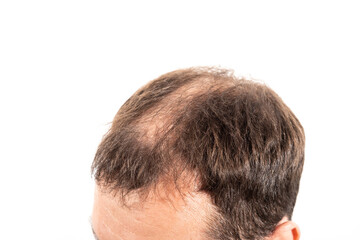 Close-up balding head of a young man on a white isolated background.
