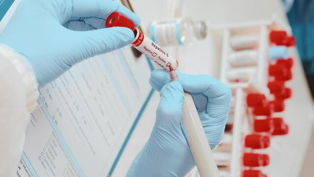 Vertical video of Positive test result for hepatitis C disease in hands doctor laboratory assistant making mark on flask with infected blood of patient who has given analysis in private clinic.
