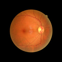 Photo Madical Retina Abnormal isolated on black background.Retina of diabetes , diabates retinopathy.