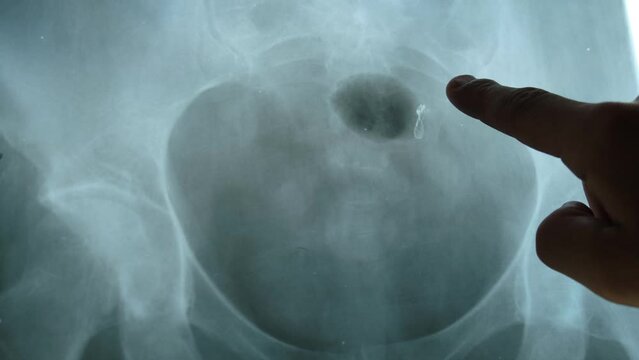 Doctor shows kidney stone on patient's MRI image, close-up