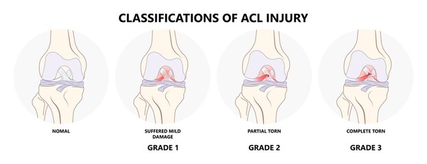 ACL injury knee tear torn Arthroscopy bone Pain swollen range of motion grade thighbone Rest Ice treat first aid heal