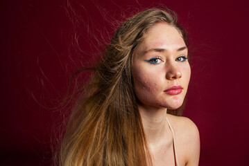 Naklejka premium Beautiful model girl woman with allergy on her face. Red background. woman having problems of acne inflammation (Papule and Pustule) on her face. Conceptual of problems on woman skin. Body positive.