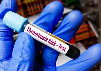 Doctor holding Blood tube for Thrombosis Risk factor test. Bleeding disorder.