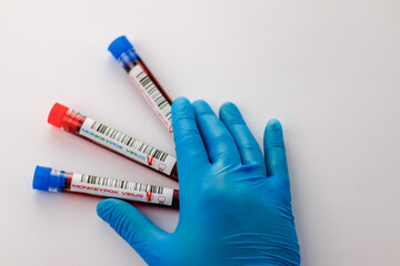 flasks with blood tests for monkey pox virus positive and negative