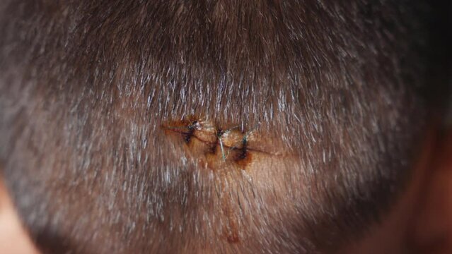 The lacerated sutured wound of kid back head which suture by nylon suture about 3 stitches at the emergency room of the hospital, Medical care of the surgery lesion on the head, children of Accident