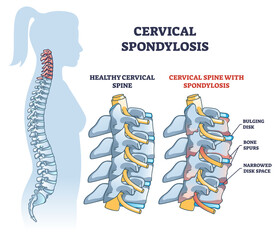 Cervical spondylosis problem compared with healthy spine outline diagram. Labeled educational scheme with human backbone disk bulging, bone spurs and narrowed space explanation vector illustration. - obrazy, fototapety, plakaty