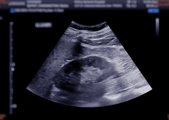 Ultrasound upper abdomen showing  kidney.