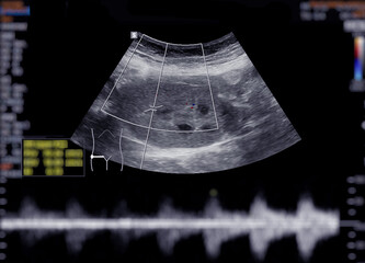 Ultrasound upper abdomen showing  kidney.