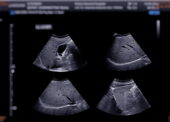 Ultrasound upper abdomen showing  gallbladder for diagnosis gallbladder stone.