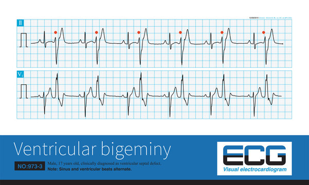 A 17 Year Old Male Was Clinically Diagnosed As Ventricular Septal Defect And His ECG Was Ventricular Bigeminy.Ventricular Premature Contraction Originated In The Left Posterior Fascicular Region.