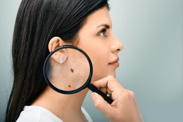 Woman with magnifying glass showing mole and birthmark on her body for prevention of melanoma and nevus exam. Mole dermoscopy - obrazy, fototapety, plakaty
