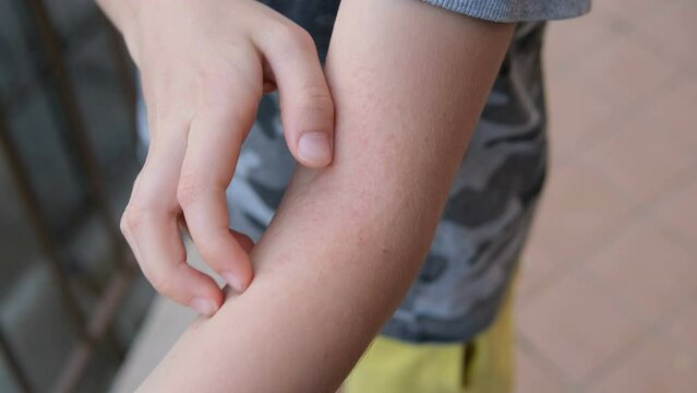 Little child scratches his arm with atopic dermatitis rash. Health care skin allergy