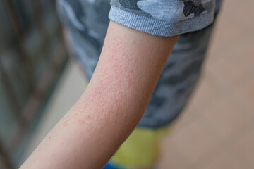 Little child arm with atopic dermatitis rash. Health care skin allergy sickness