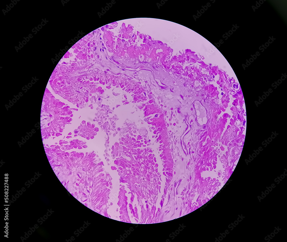 Sticker Histology of metastatic papillary adenocarcinoma.