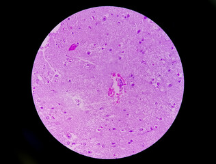 Histology of metastatic papillary adenocarcinoma.
