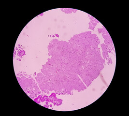 Histology of metastatic papillary adenocarcinoma.