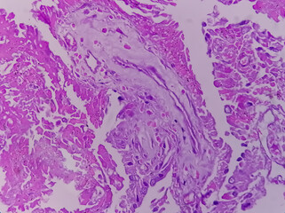 Histology of metastatic papillary adenocarcinoma.