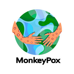 Monkeypox virus. Eruption on the body. Monkey Pox virus disease symptoms on hands rash infection. Global pandemic in the world. Vector illustration isolated