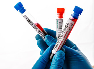 flasks with blood tests for monkey pox virus positive and negative