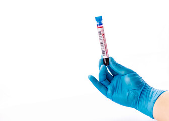 flasks with blood tests for monkey pox virus positive and negative, coronavirus, blood test