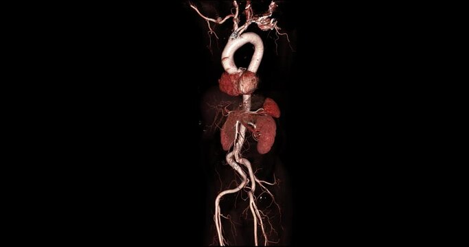  CTA Whole aorta 3D rendering turn around on the screen for diagnosis Aortic dissection or aneurysm.