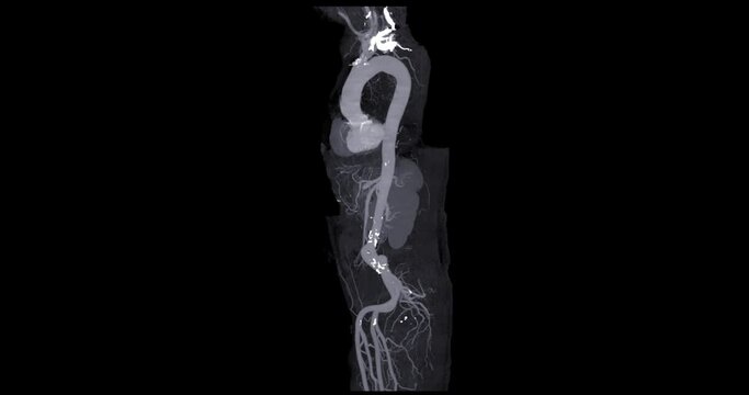 CTA Whole aorta 3D rendering turn around on the screen for diagnosis Aortic dissection or aneurysm.