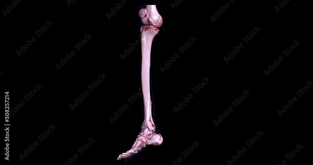 Poster ct scan of leg 3d rendering for diagnosis bone fracture.