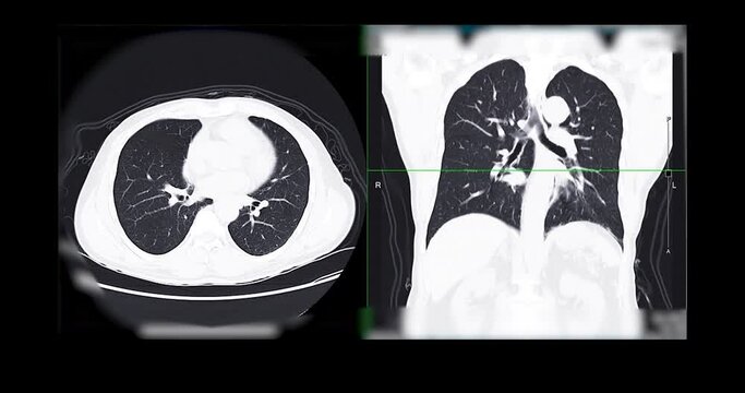 CT Chest or CT Scan of  Lung axial and Coronal for diagnosis TB,tuberculosis and coronavirus or covid-19 .
