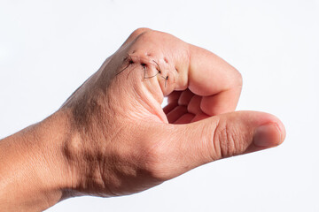 Hand injured by a cut. Surgical suture made by a surgeon. Cut in the hand with knife, scissors,...