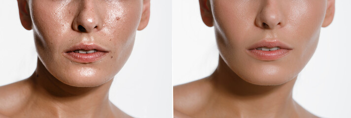 before and after excision of a nevus spots on a woman's cheek with a laser in a cosmetology clinic,...