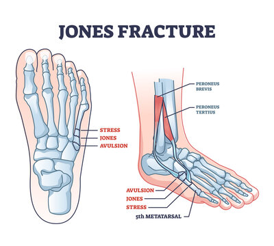 Jones fracture and foot pinky finger bone broken damage outline diagram. Labeled educational scheme with bone stress or avulsion sections vetor illustration. Peroneus brevis and tertius muscle anatomy