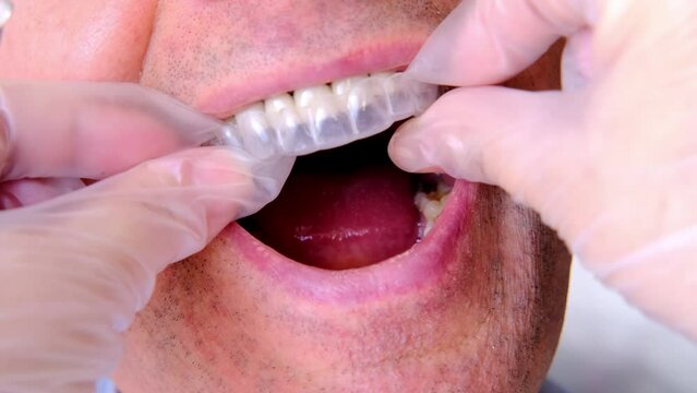closeup male doctor conducts an examination of oral cavity of old male patient, tries on Silicone Night Mouth Guard for Teeth Clenching Grinding Dental Bite Sleep Aid, concept of dental services