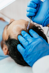Handsome middle age man receiving advanced Platelet Rich Plasma PRP treatment against hair loss....
