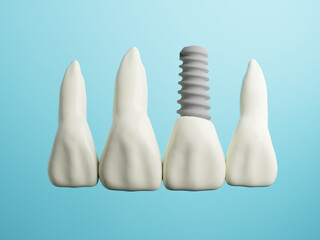 Odontologia Implantes Dentales Dentista