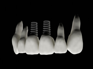 Implantes Dentales Odontologia