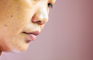 Photo of 40 years old Asian woman with acne, wrinkle, fleck, and blemish on her face. Health and skin problem concept.