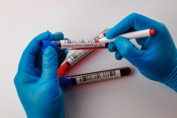 flasks with blood tests for monkey pox virus positive and negative